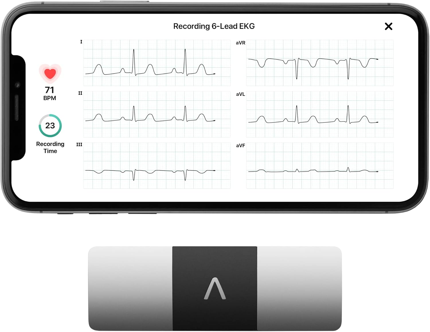 KardiaMobile 6-Lead Personal EKG Monitor – Six Views of The Heart – Detects AFib and Irregular Arrhythmias – Instant Results in 30 Seconds – Works with Most Smartphones - FSA/HSA Eligible